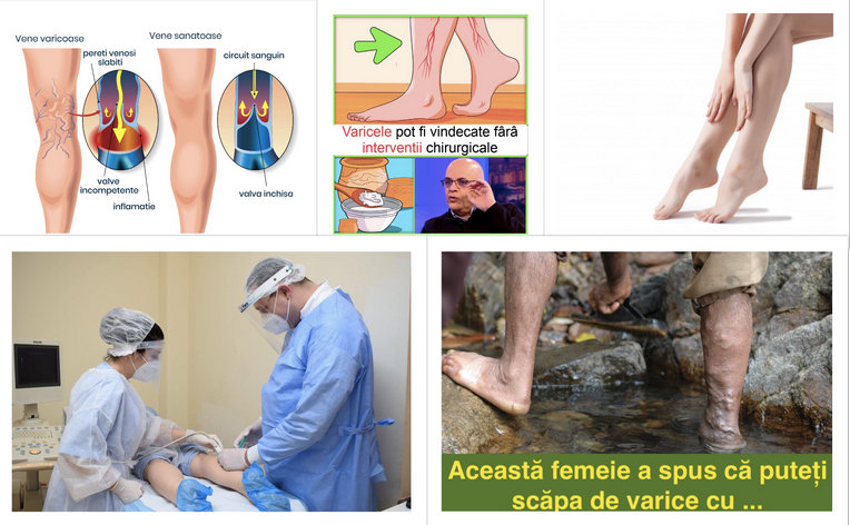 femeie varicose foot